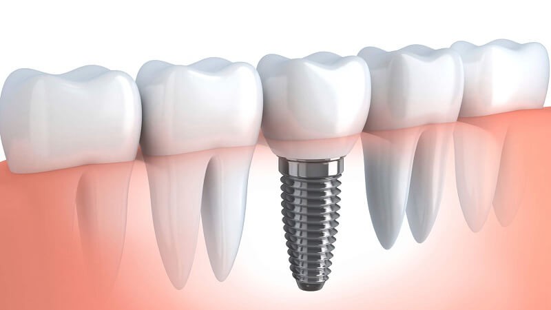 Виды зубных имплантов