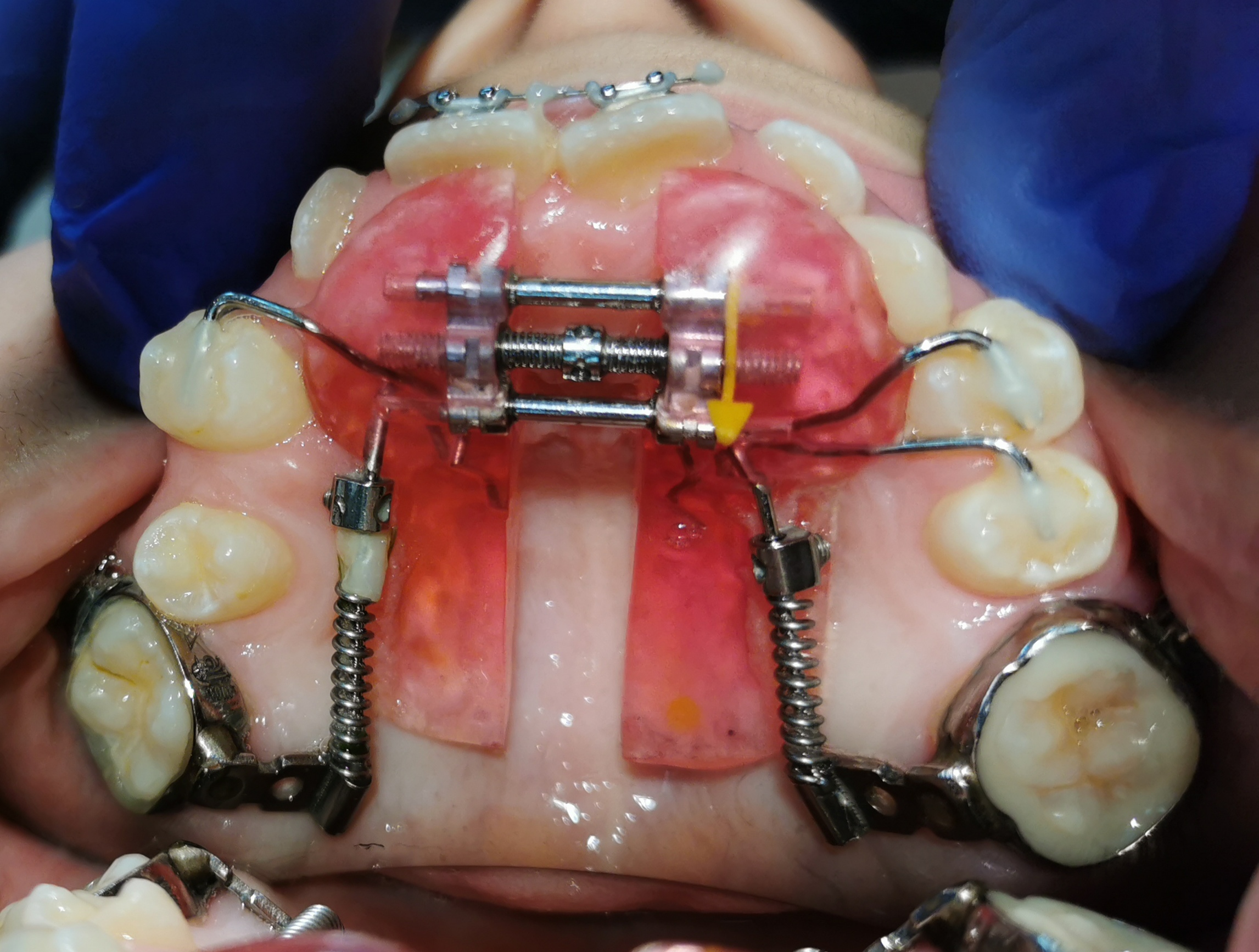 Несъемный аппарат с дистализацией 6 зубов